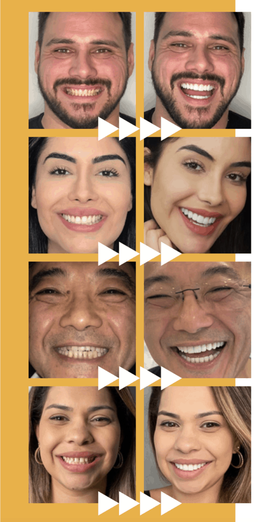 What Are Dental Veneers? Before & After Look