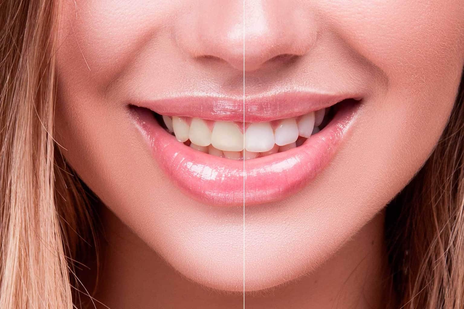 Unbeatable Teeth Whitening Promotion at VIP Dental