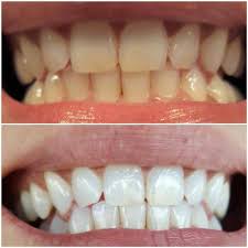 LASER TEETH WHITENING BEFORE & AFTER... - High Dent Center | Facebook