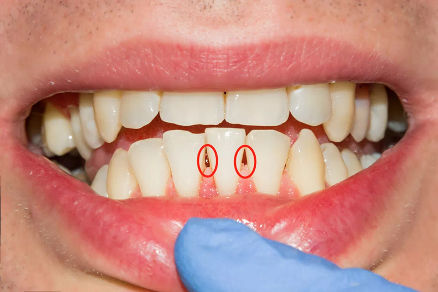 ARRAIL Dental Free Teeth Cleaning